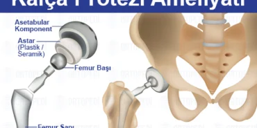 Kalça Protezi Hakkında Bilmeniz Gereken Her Şey Adım Adım Rehber
