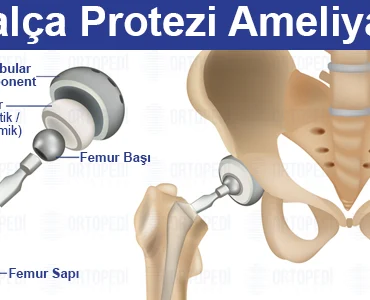 Kalça Protezi Hakkında Bilmeniz Gereken Her Şey Adım Adım Rehber